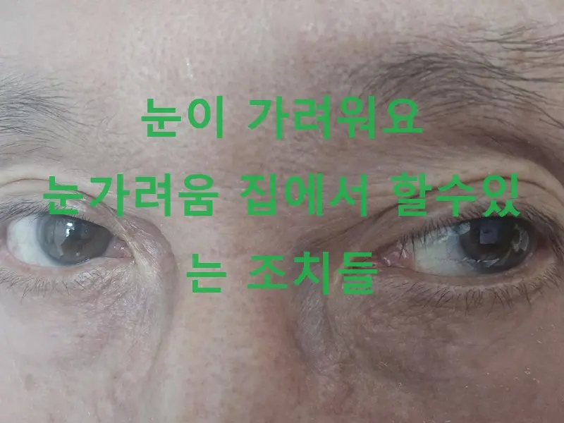 눈이 가려워요: 눈가려움 집에서 할수있는 조치들